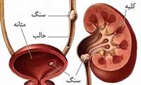 هر آنچه در رابطه با سنگ کلیه و علائم آن باید بدانید